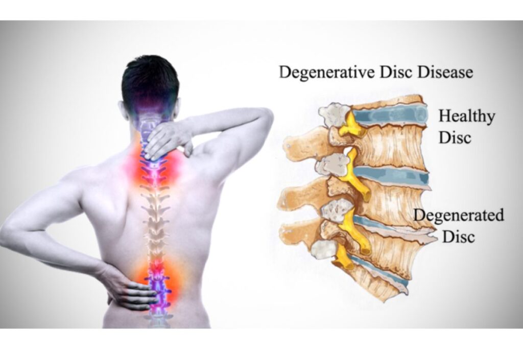 Degenerative Disc Disease